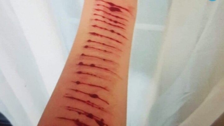 Ρόδος: 12χρονη χαρακώθηκε με ξυράφι “υπακούοντας” σε εντολές μέσω chat – Την πρόλαβαν πριν πάρει χάπια