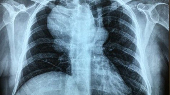 Νέα μελέτη: Οι πολλές ακτινογραφίες και αξονικές τομογραφίες αυξάνουν τον κίνδυνο για καρκίνο των όρχεων