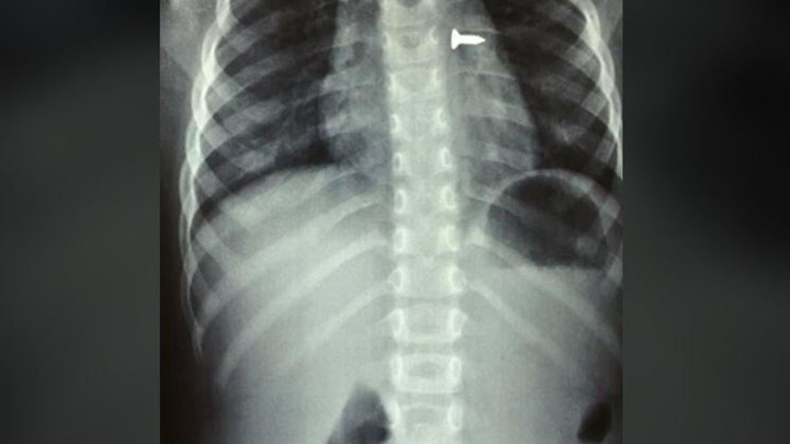 Εικόνες-σοκ: Κοριτσάκι 3 ετών κατάπιε βίδα που κατέληξε στον πνεύμονα