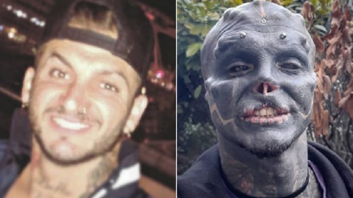 Άνδρας έγινε… “μαύρος εξωγήινος” αφαιρώντας μύτη και άνω χείλος – ΦΩΤΟ