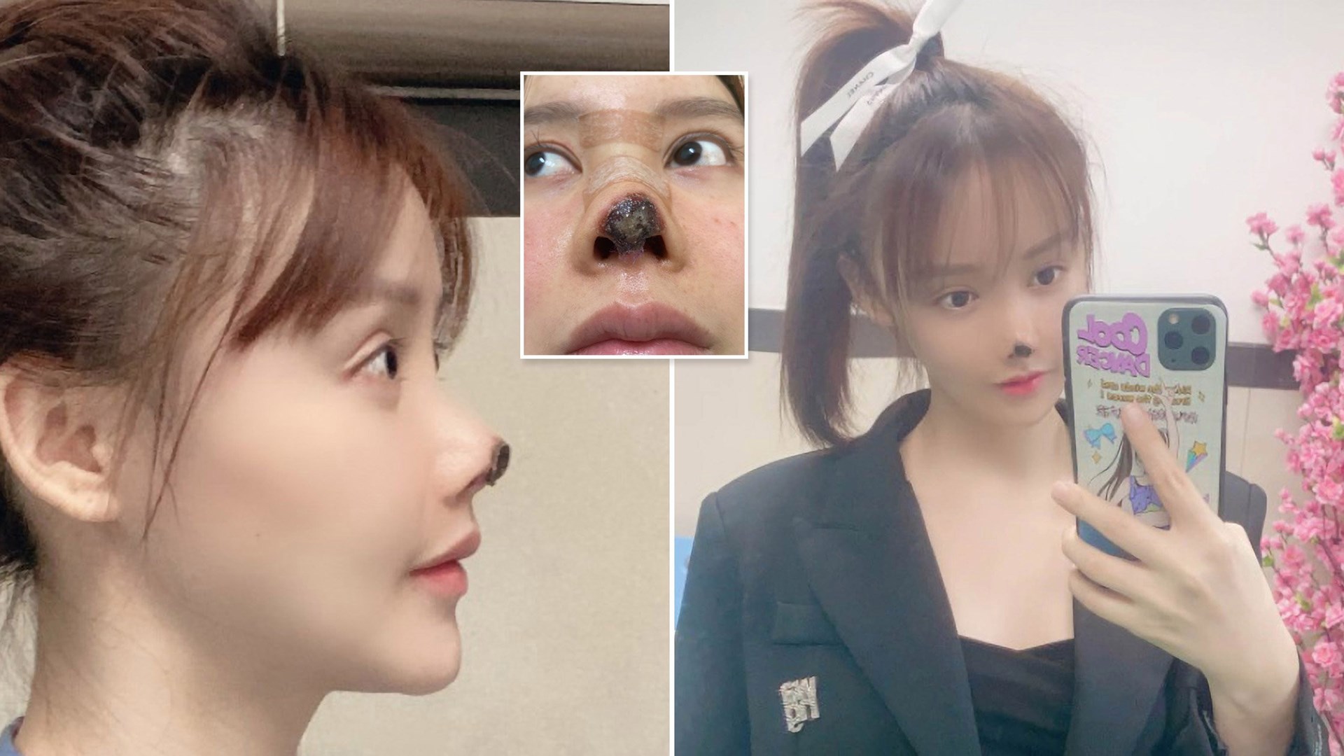 Κινέζα ηθοποιός προειδοποιεί για τις πλαστικές – Ο “εφιάλτης” που ζει έπειτα από επέμβαση στη μύτη