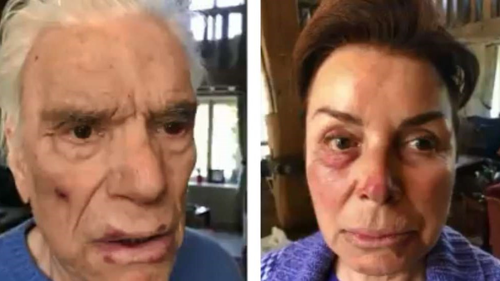 Μπερνάρ Ταπί: Σοκάρουν οι εικόνες από τον άγριο ξυλοδαρμό του – ΦΩΤΟ