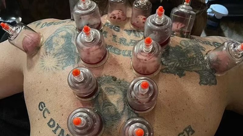 Πασίγνωστος σταρ κάνει θεραπεία με βεντούζες – “Ρουφώντας το δηλητήριο”