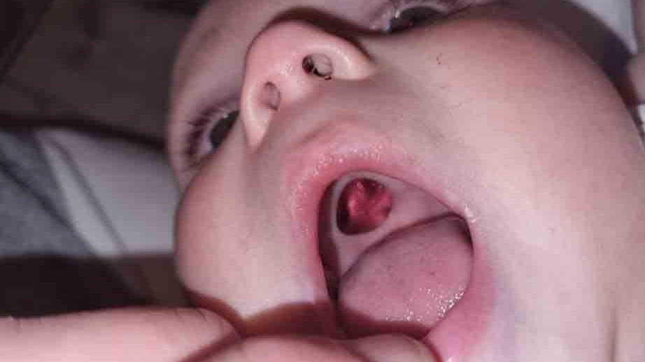 Βρετανία: Πανικός για μαμά όταν είδε μια τρύπα στον ουρανίσκο του γιου της