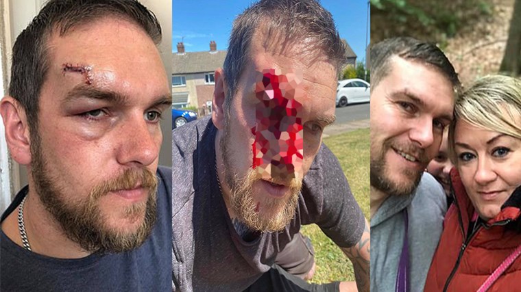 Βρετανία: Συνταξιούχος πυροβόλησε τον γείτονά του στο πρόσωπο – Η αιτία της αντιδικίας