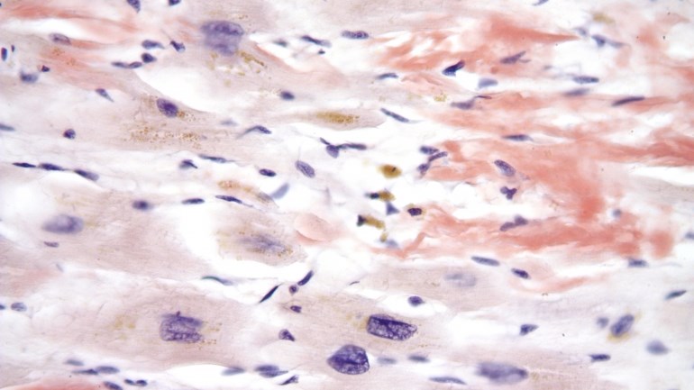 Το ΕΚΠΑ πρωτοστατεί στην Κλινική Έρευνα για την έγκριση νέας θεραπείας για την Αμυλοείδωση