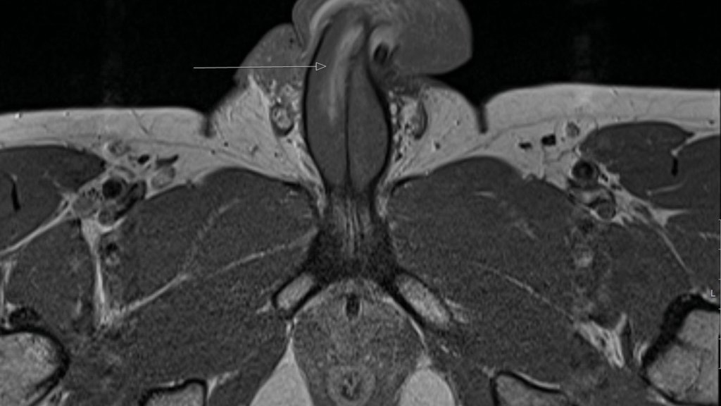 Η πρώτη περίπτωση κάθετου κατάγματος σε ανδρικό μόριο – Πώς το έπαθε