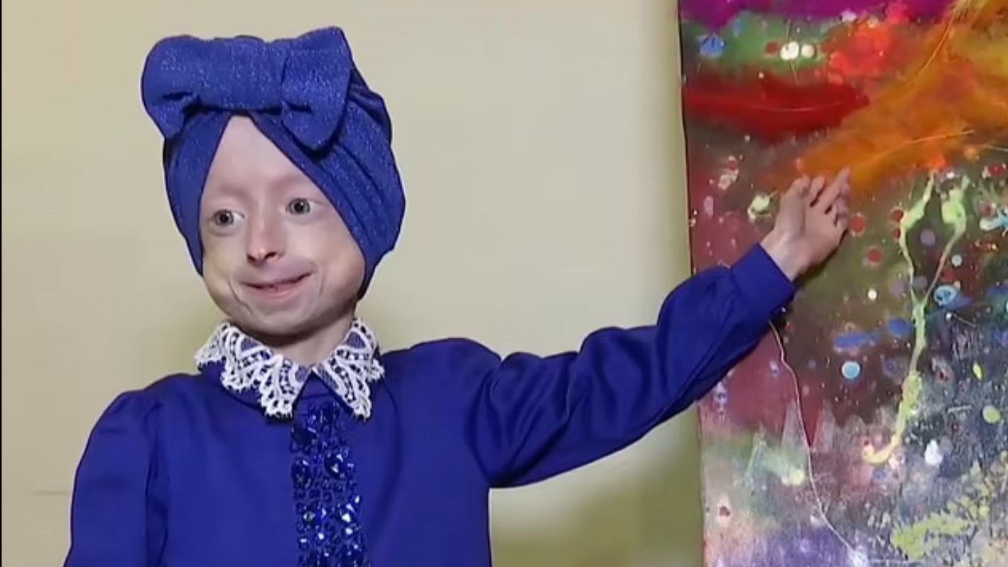 Πέθανε η 10χρονη Ιρίνα που έπασχε από προγηρία – Είχε το σώμα 80χρονης