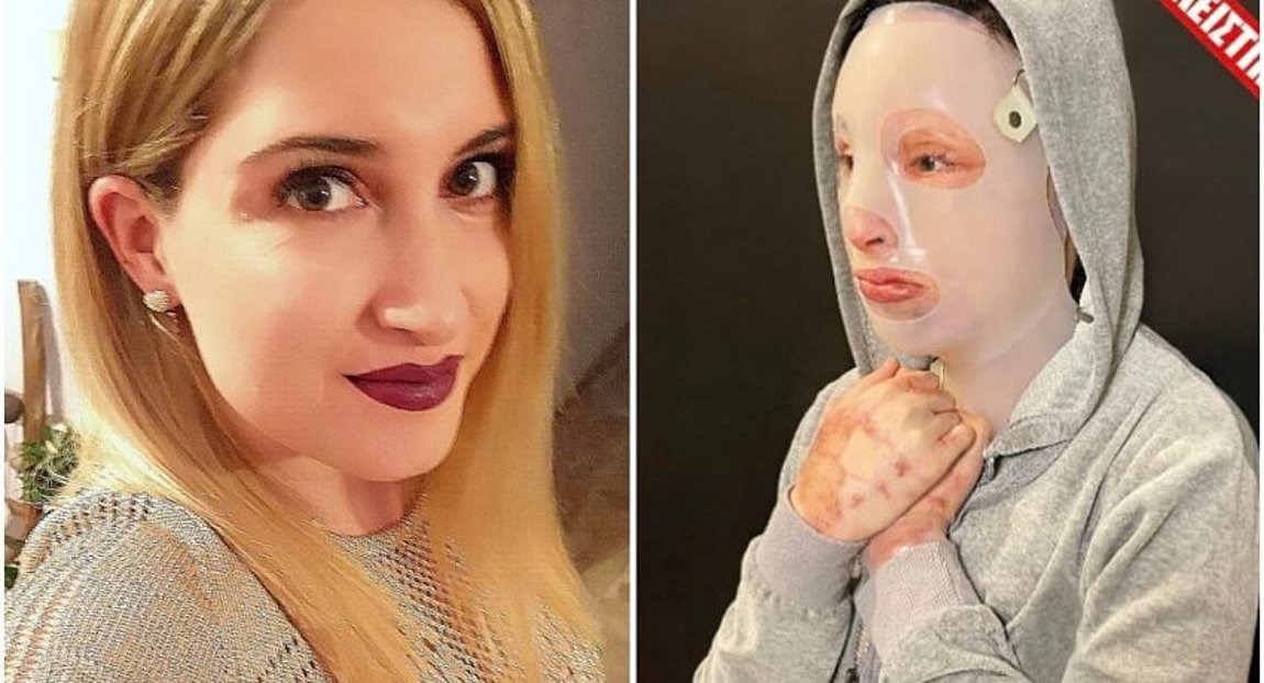 Επίθεση με βιτριόλι – “Eπίπονο, αλλά θα πάω στο δικαστήριο να το αντιμετωπίσω” δηλώνει η Ιωάννα