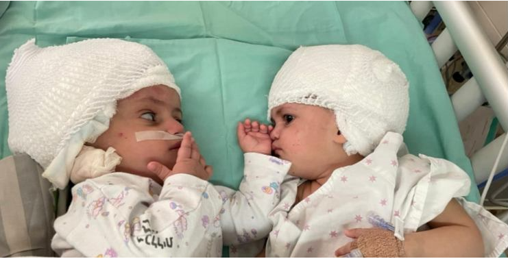 Ισραήλ: Σπάνια εγχείρηση σε σιαμαία κοριτσάκια – Η στιγμή που κοίταξε το ένα το άλλο