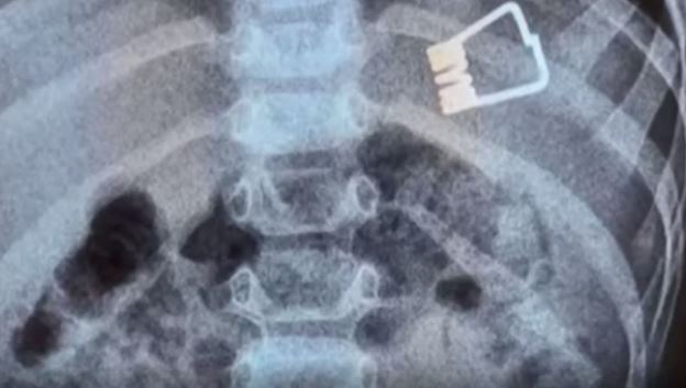 Λήμνος-μωρό-μανταλάκι