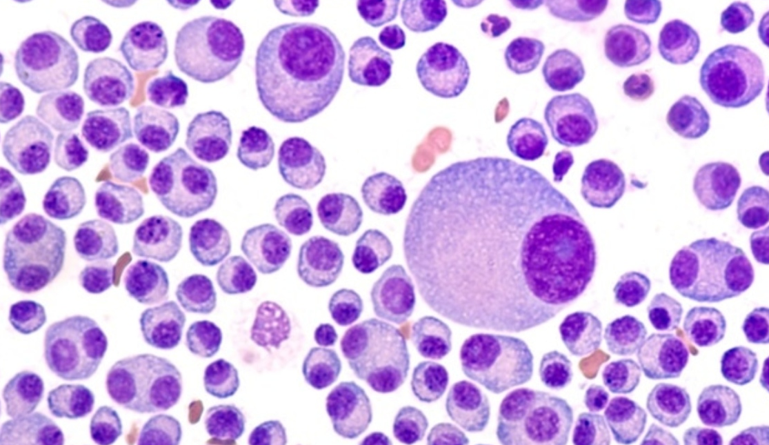 Πολλαπλό μυέλωμα