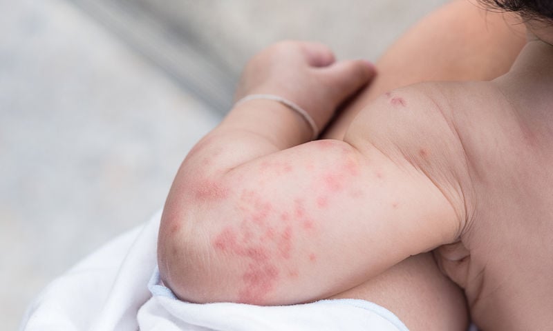 «Καμπανάκι» ΠΟΥ για τα κρούσματα ιλαράς στην Ευρώπη – Πόσο αυξήθηκαν το 2023