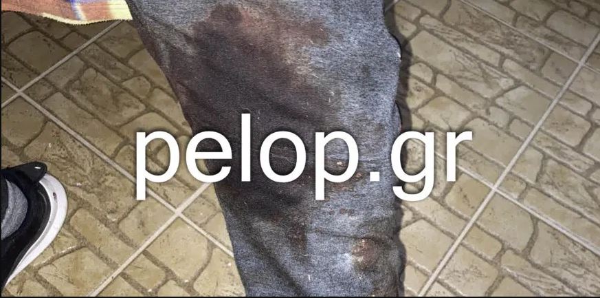 Πάτρα- επίθεση-σκύλος