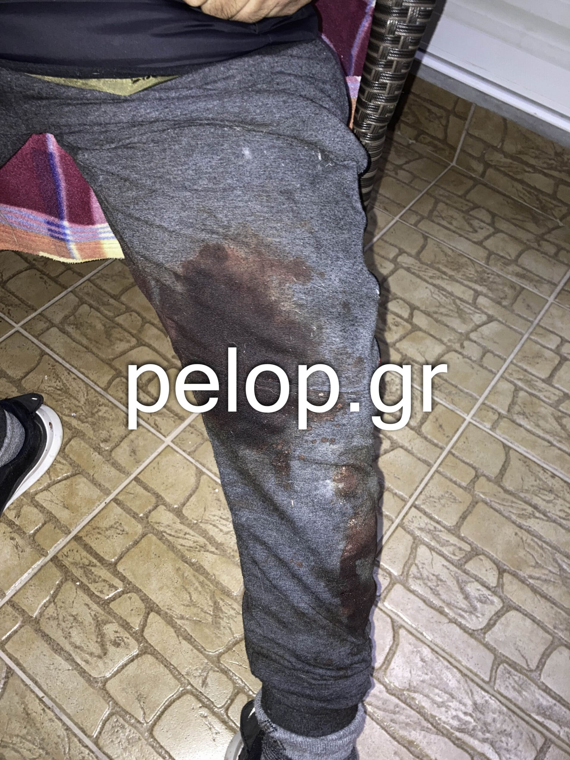 Πάτρα- επίθεση- σκύλος