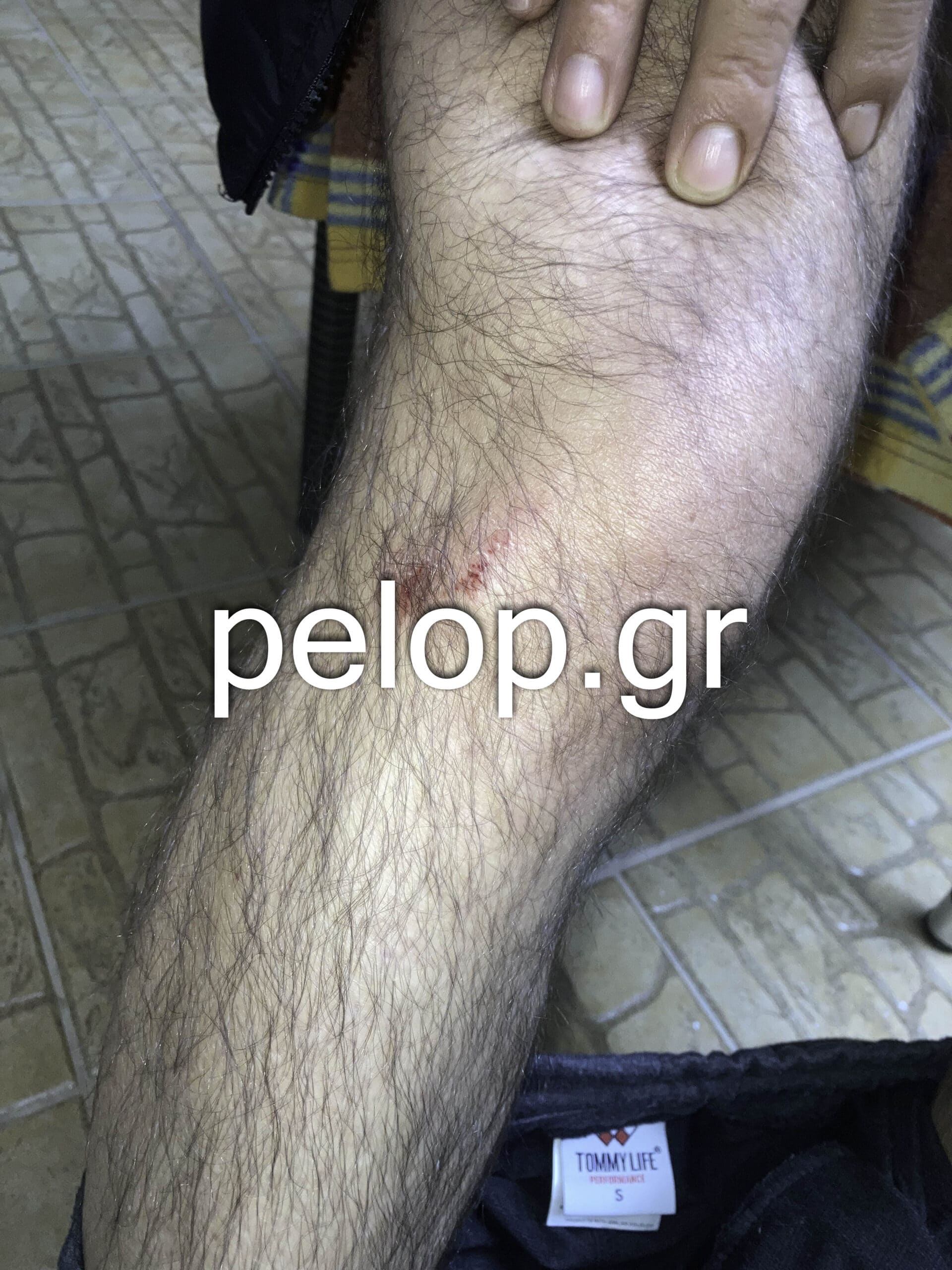 Πάτρα- επίθεση- σκύλος