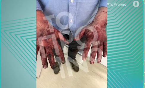 Τζώρτζης Μονογυιός: Σοκάρουν οι εικόνες με τα εγκαύματα του φίλου του που τον απεγκλώβισε από τη Ferrari