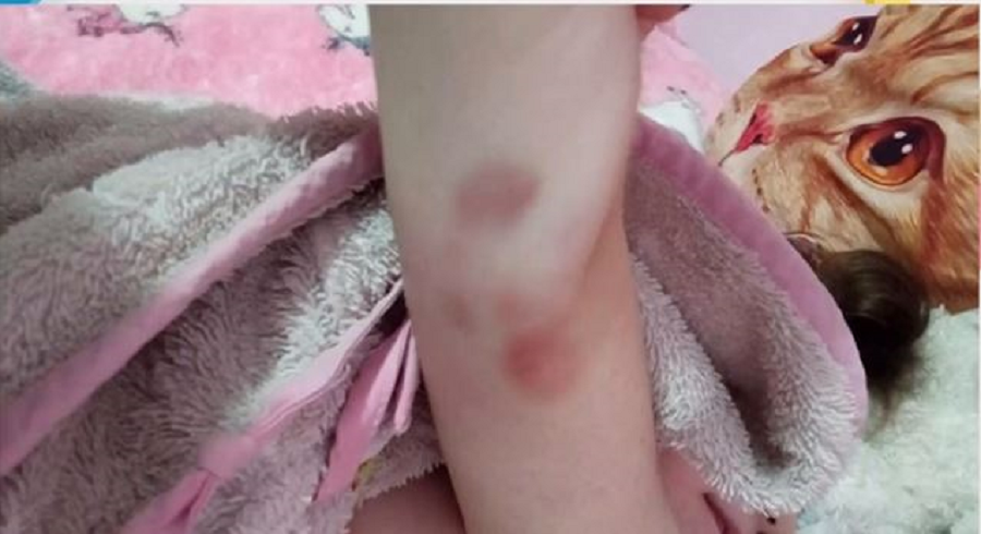 μελανιές Τζωρτζίνα Πάτρα