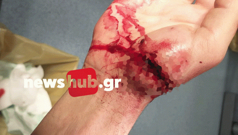 σκύλος- επίθεση-τραύμα