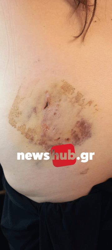 σκύλος- επίθεση