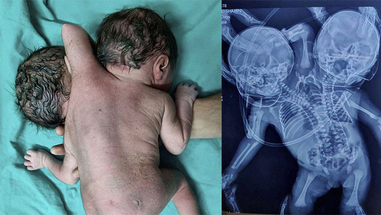 Ινδία: Γεννήθηκε βρέφος με δύο κεφάλια, τρία χέρια και δύο καρδιές – Έκπληκτοι οι γιατροί