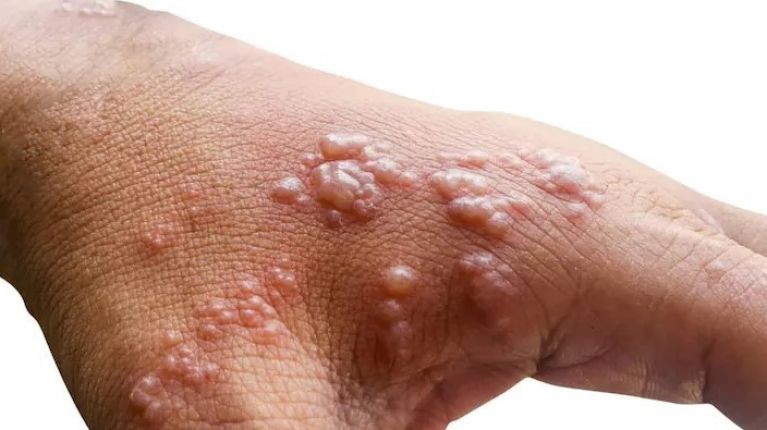 ευλογιά των πιθήκων