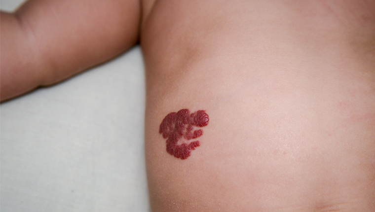 Τι είναι το αιμαγγείωμα που έχει ο Λάκης Παπαδόπουλος