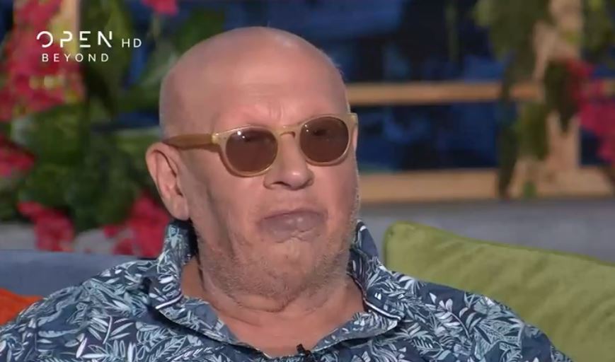 Λάκης Παπαδόπουλος: Όσα είπε για το χαρακτηριστικό σημάδι που έχει στο πρόσωπο