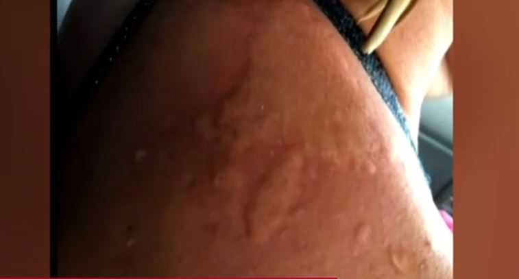 μωβ μέδουσα- σημάδι