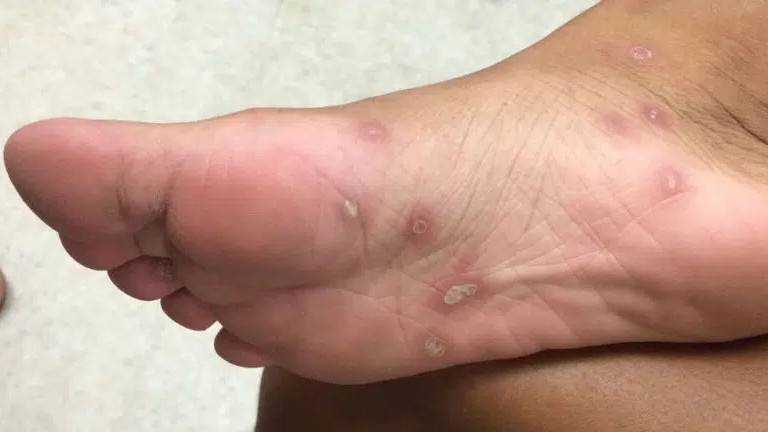 Πάτρα: 16χρονη διαγνώστηκε με σύφιλη – Το «σκάει» συχνά από ίδρυμα της πόλης