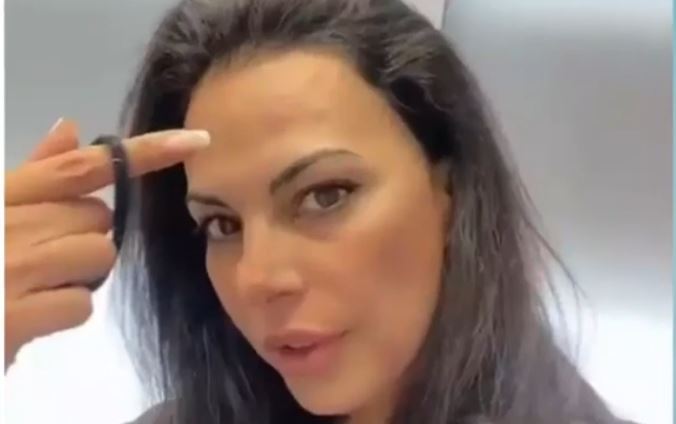 Η Εύη Βατίδου δείχνει τα σημάδια από τις ενέσεις μπότοξ