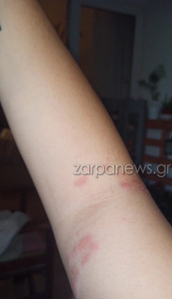 μωβ μέδουσες τσίμπημα γυναίκας στα Χανιά