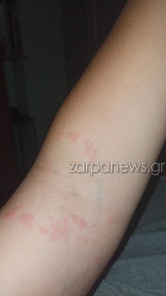 μωβ μέδουσες τσίμπημα γυναίκας στα Χανιά