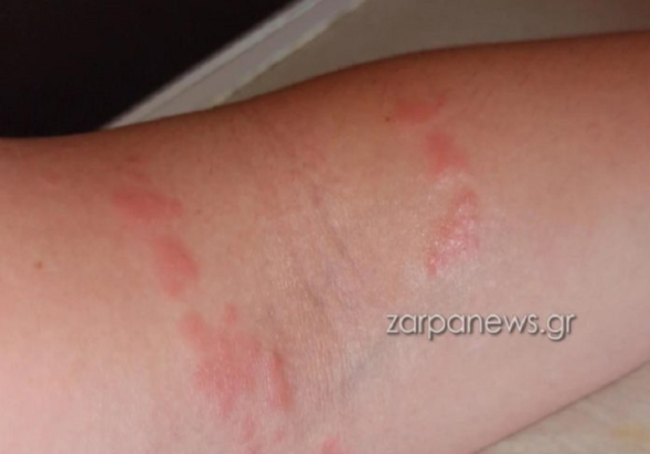 μωβ μέδουσες τσίμπημα γυναίκας στα Χανιά