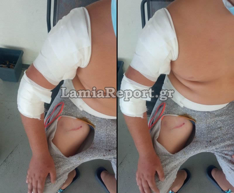 Φθιώτιδα: Αδέσποτα σκυλιά δάγκωσαν παιδάκι και το έστειλαν στο νοσοκομείο – Πώς κατάφερε να σωθεί από τα δόντια τους