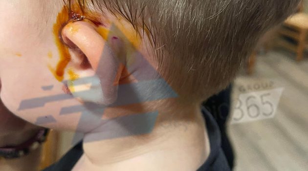 Αγρίνιο: Αδέσποτο σκυλί τραυμάτισε αγοράκι στην κεντρική πλατεία