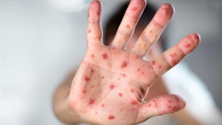 γρίπη της ντομάτας