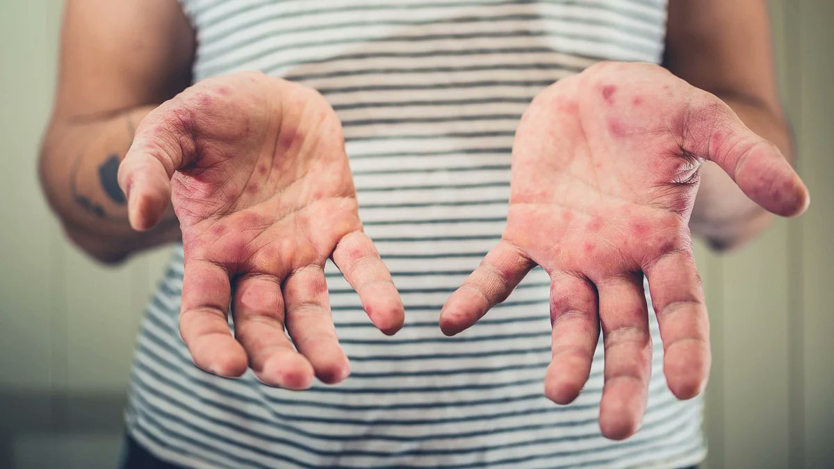 γρίπη της ντομάτας