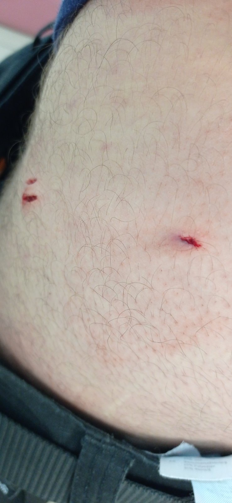 τραυματισμός εργαζομενου στο νοσοκομείο Χανίων