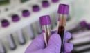 Νέα μελέτη: Η ομάδα αίματος επηρεάζει τον κίνδυνο πρόωρου εγκεφαλικού πριν από τα 60