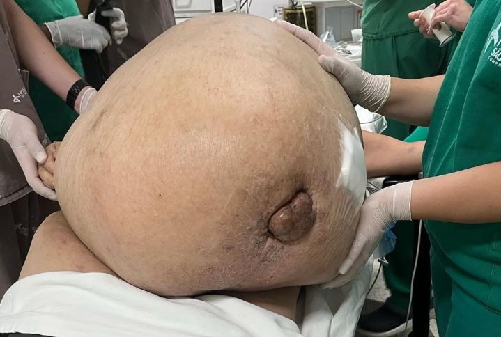 όγκος Βραζιλία