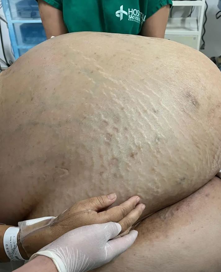 όγκος σε γυναίκα στη Βραζιλία 