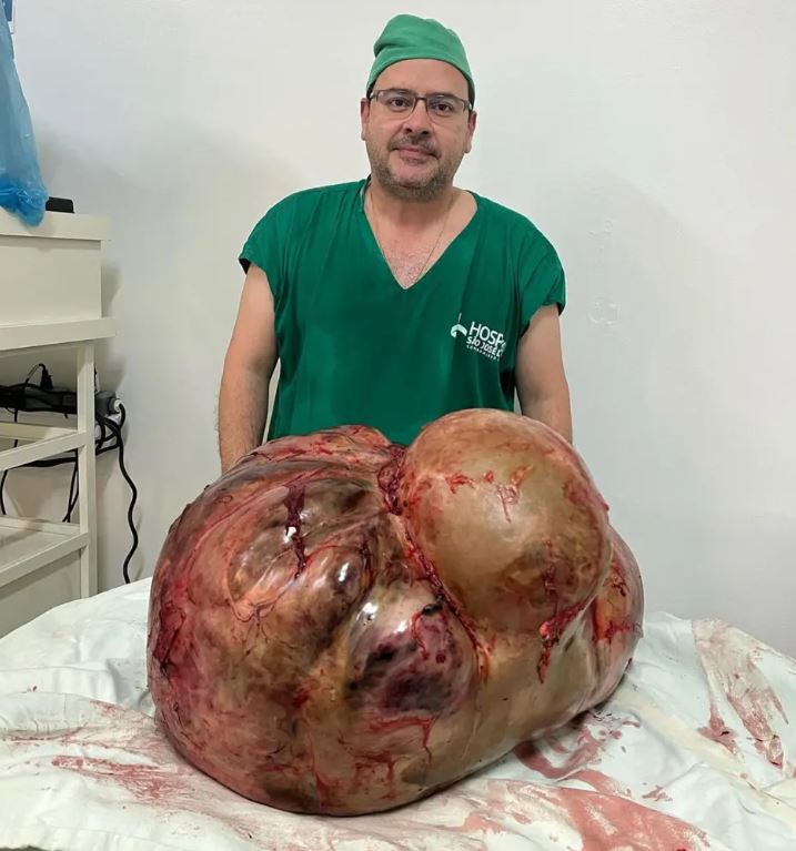 όγκος σε γυναίκα στην Βραζιλία 