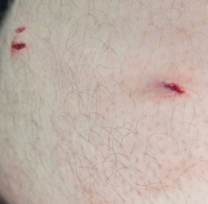 ασθενής επιτέθηκε και τραυμάτισε υπάλληλο ασφαλείας