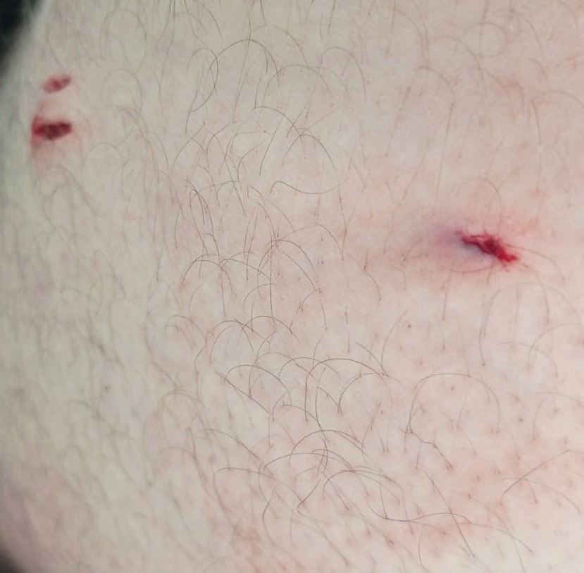 ασθενής επιτέθηκε και τραυμάτισε υπάλληλο ασφαλείας