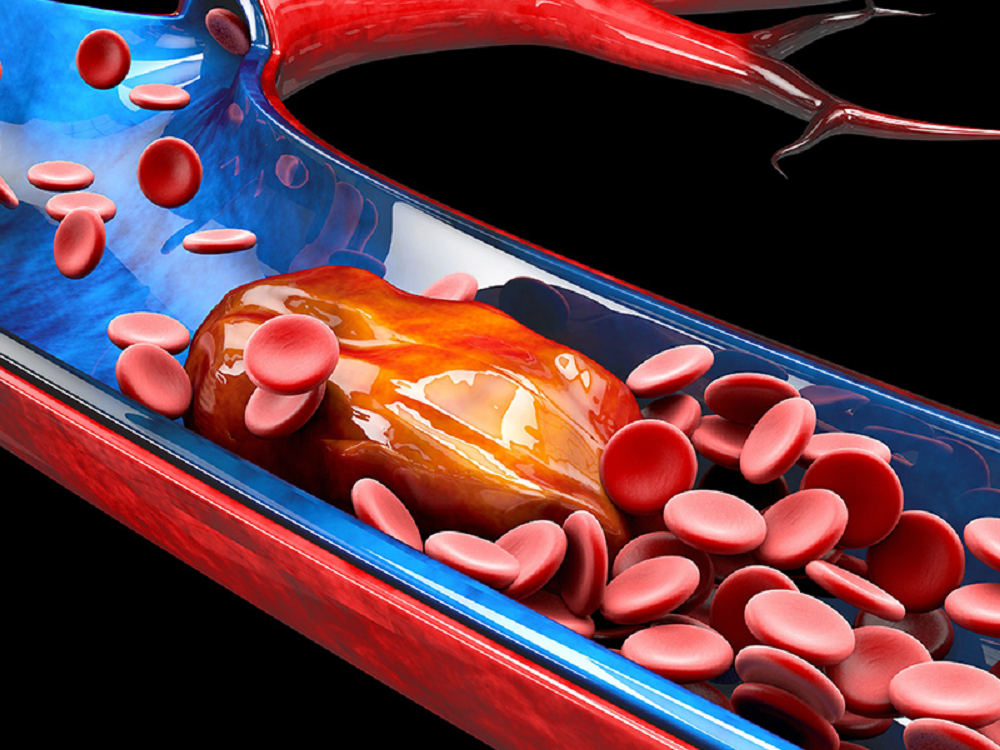 Φλεβικής Θρομβοεμβολής