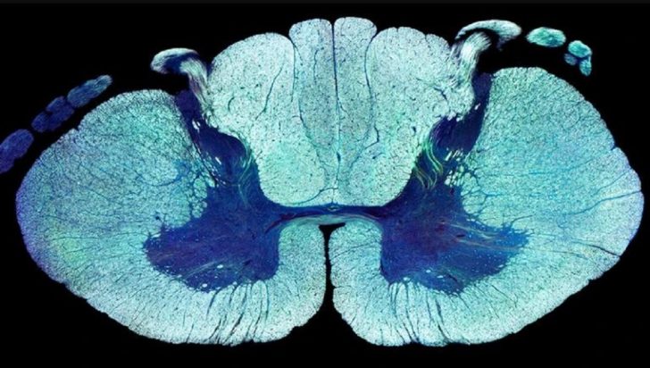 νευρώνες παράλυση