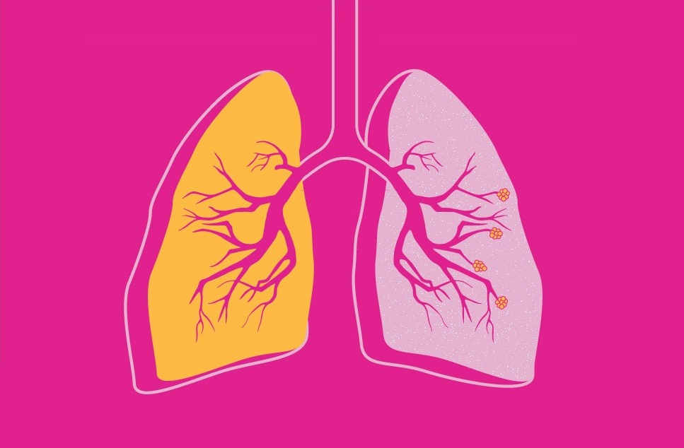 Χρόνια αποφρακτική πνευμονοπάθεια