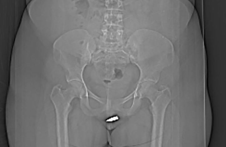 Σομαλία: Για πρώτη φορά αφαιρέθηκε σφαίρα από την κλειτορίδα γυναίκας