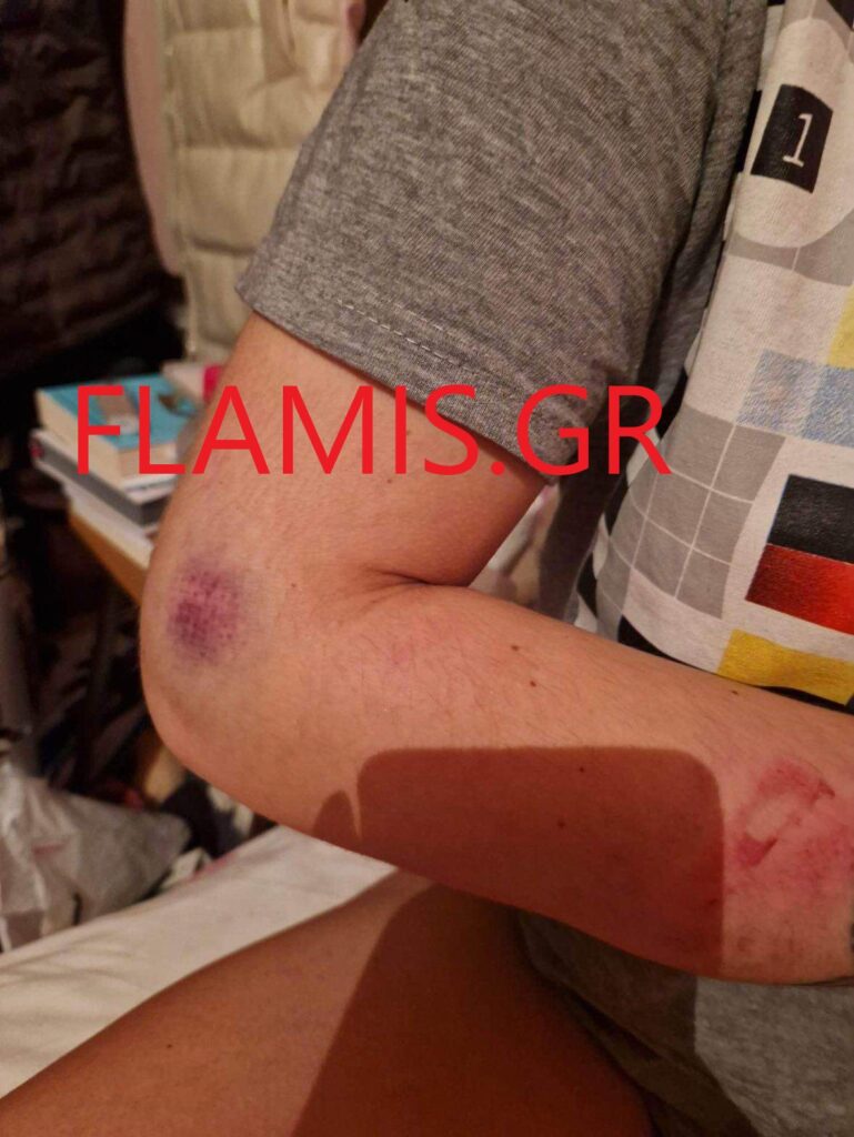 Πάτρα: Ξυλοδαρμός 31χρονης